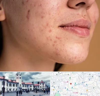 درمان جای جوش در میدان شهرداری رشت 