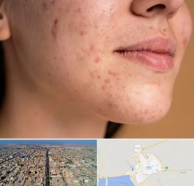 درمان جای جوش در بندر ماهشهر