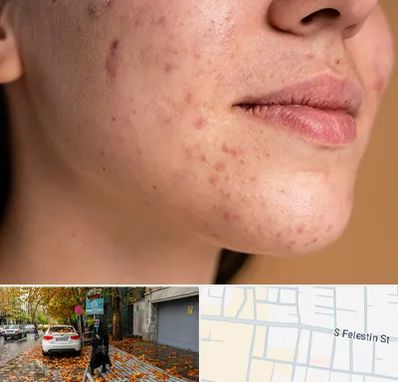 درمان جای جوش در خیابان فلسطین