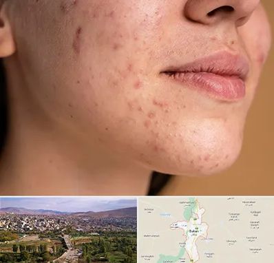 درمان جای جوش در بوکان