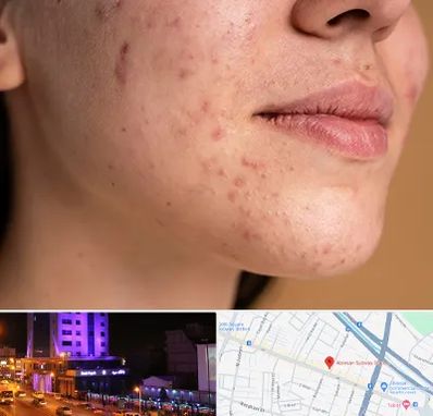 درمان جای جوش در آبرسان تبریز