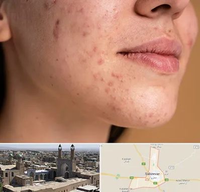 درمان جای جوش در سبزوار