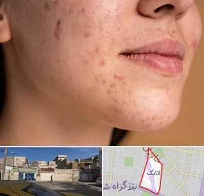 درمان جای جوش در اتابک