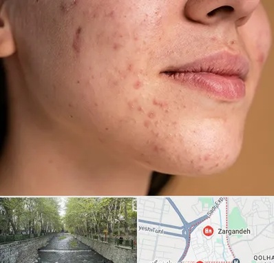 درمان جای جوش در زرگنده