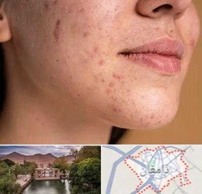 درمان جای جوش در دامغان