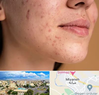 درمان جای جوش در میانه