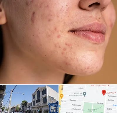 درمان جای جوش در افسریه 