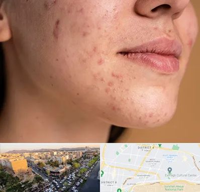 درمان جای جوش در تهرانپارس 