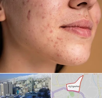 درمان جای جوش در محمودیه