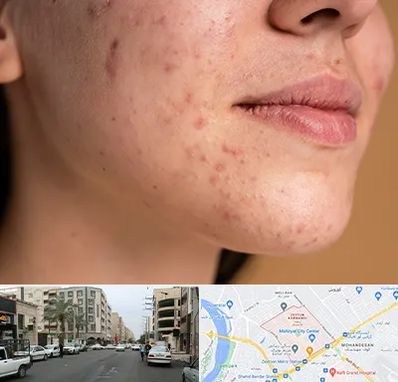 درمان جای جوش در زیتون کارمندی اهواز 