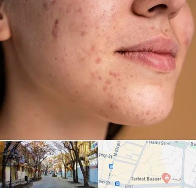 درمان جای جوش در تربیت تبریز