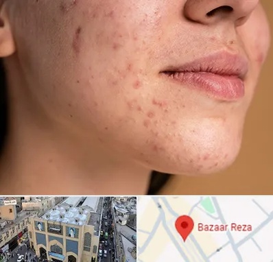 درمان جای جوش در بازار رضا مشهد
