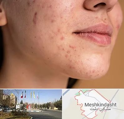 درمان جای جوش در مشکین دشت