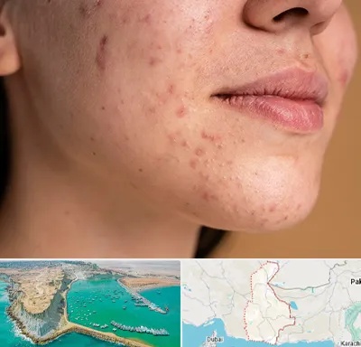 درمان جای جوش در سیستان و بلوچستان
