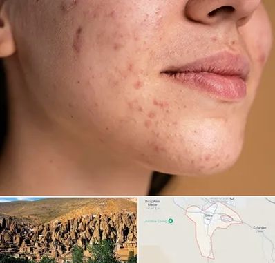 درمان جای جوش در اسکو