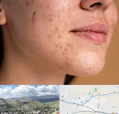 درمان جای جوش در رودهن