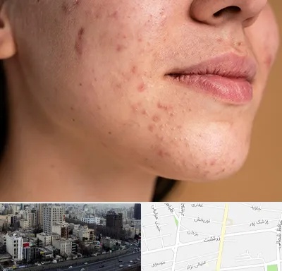 درمان جای جوش در زرتشت