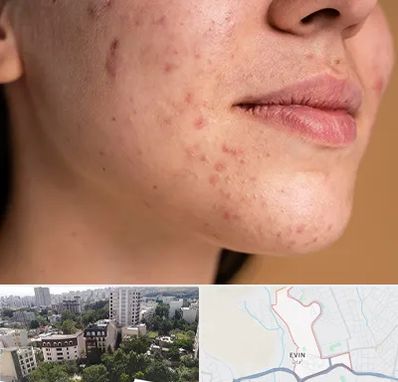 درمان جای جوش در اوین