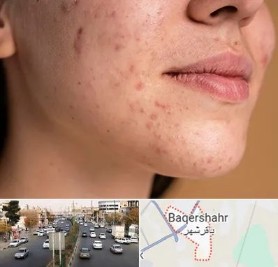 درمان جای جوش در باقرشهر