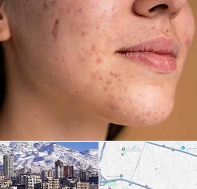 درمان جای جوش در ازگل