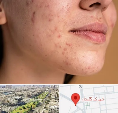 درمان جای جوش در شهرک گلستان
