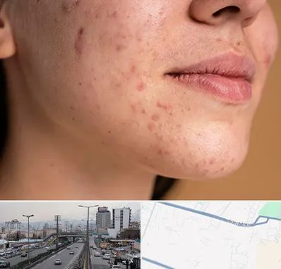 درمان جای جوش در بلوار ارتش