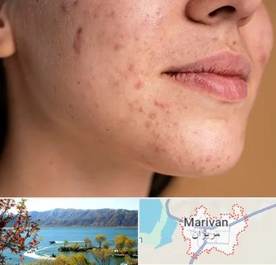 درمان جای جوش در مریوان