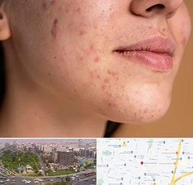 درمان جای جوش در آیت الله کاشانی 