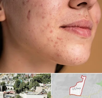 درمان جای جوش در جماران