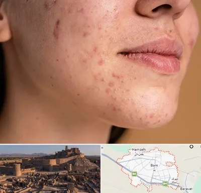 درمان جای جوش در بم