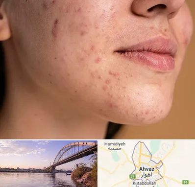 درمان جای جوش در اهواز