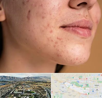 درمان جای جوش در منطقه 21 تهران 