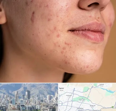 درمان جای جوش در شمال شرق تهران