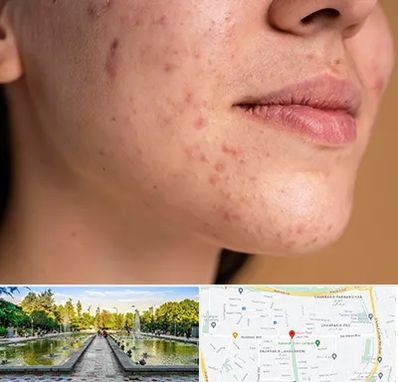 درمان جای جوش در سرسبز 