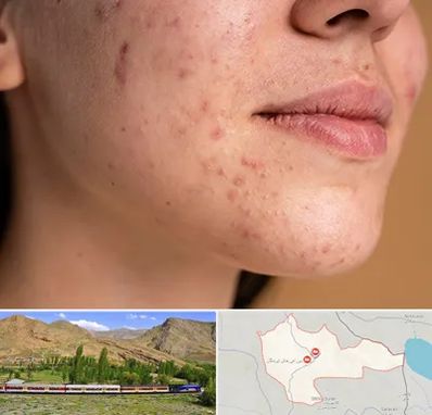 درمان جای جوش در خاش