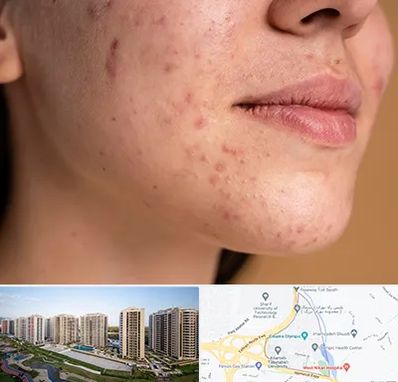 درمان جای جوش در المپیک 