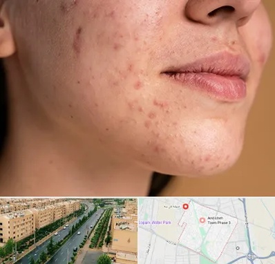 درمان جای جوش در فاز سه اندیشه
