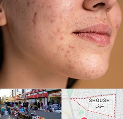 درمان جای جوش در شوش