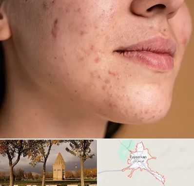 درمان جای جوش در تویسرکان