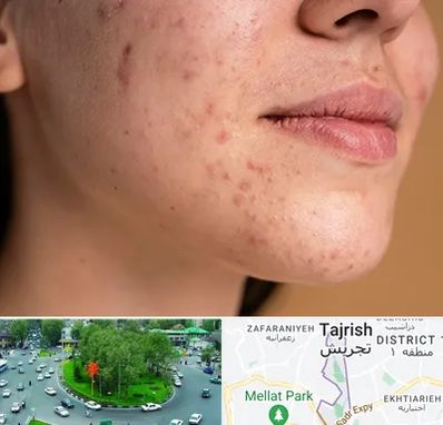 درمان جای جوش در تجریش 