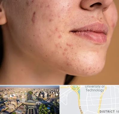 درمان جای جوش در استاد معین 