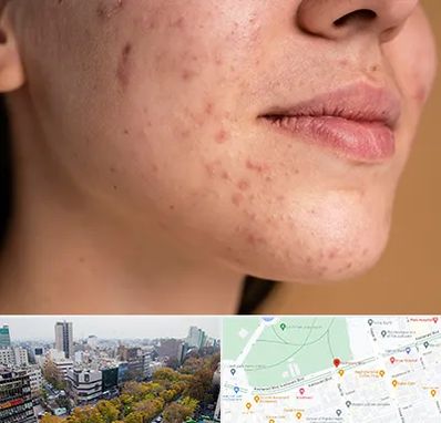 درمان جای جوش در بلوار کشاورز 