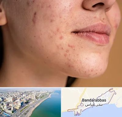درمان جای جوش در بندرعباس