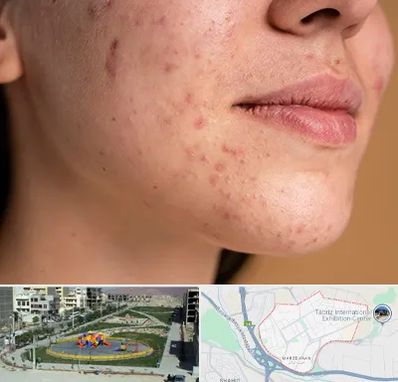 درمان جای جوش در مرزداران تبریز