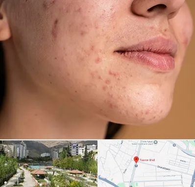 درمان جای جوش در بلوار تعاون