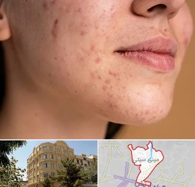 درمان جای جوش در مینی سیتی