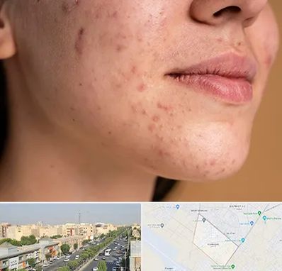 درمان جای جوش در کیانمهر کرج 