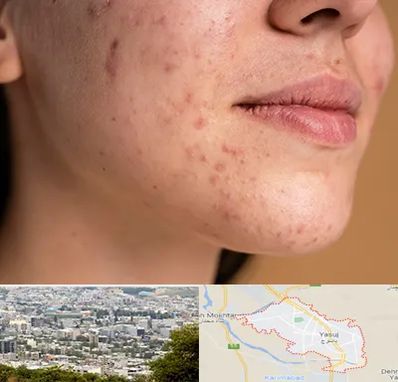 درمان جای جوش در یاسوج