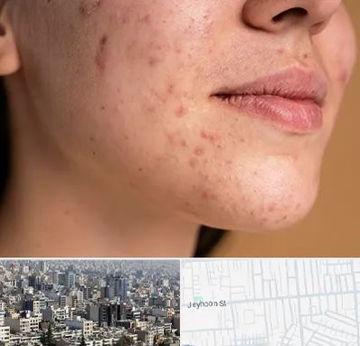 درمان جای جوش در جیحون