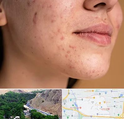 درمان جای جوش در کن 